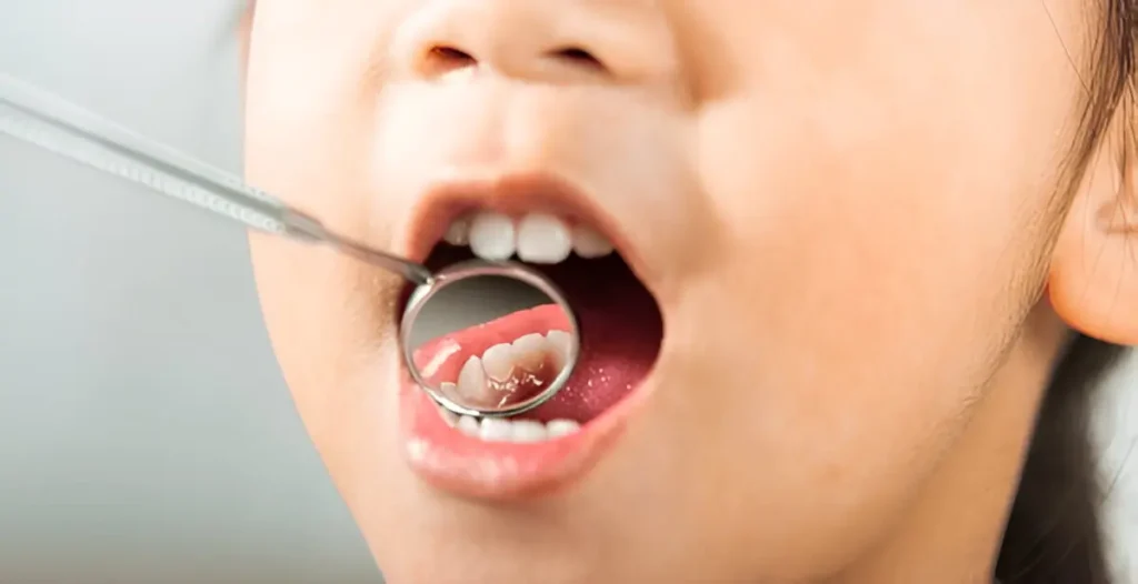 Size and Location of the Cavity