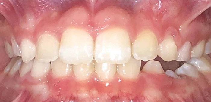 img Actual Patient Casen after 1