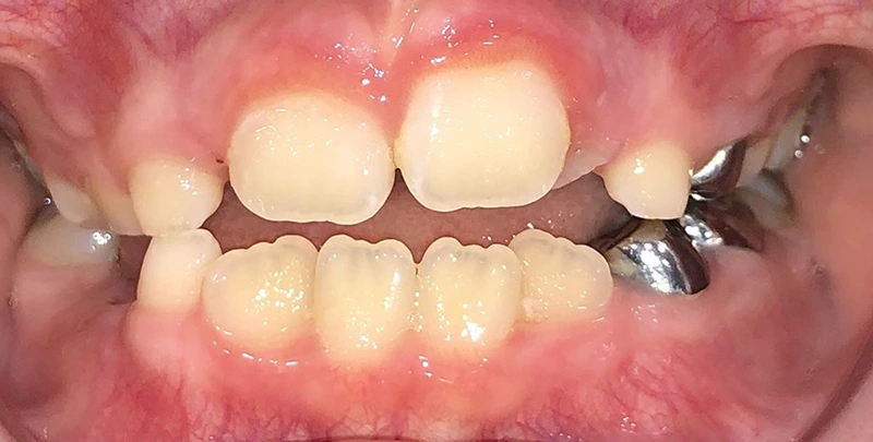 invisalign kids actual patient after 1