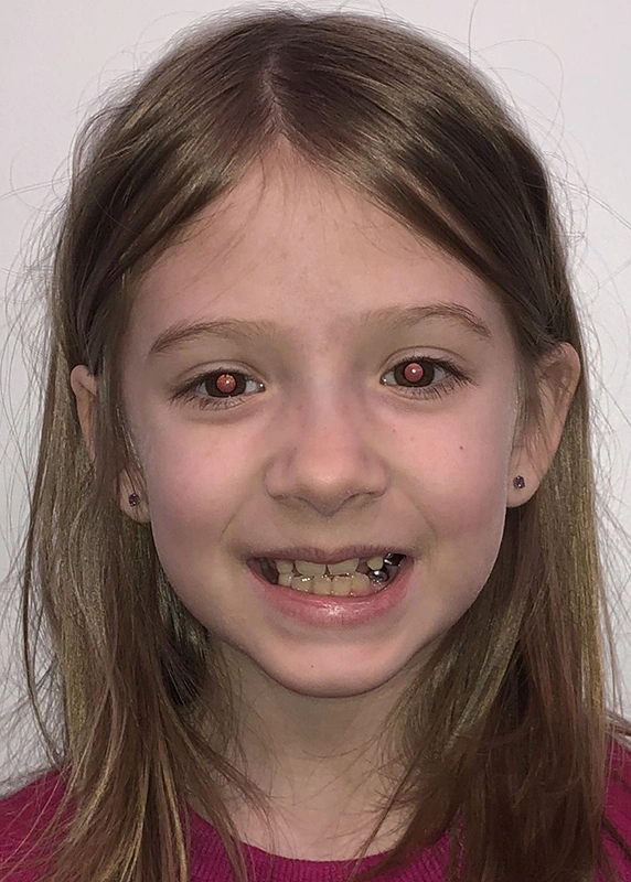 invisalign kids actual patient after