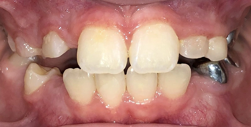 invisalign kids actual patient before 1