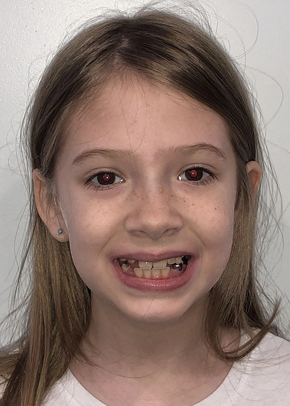 invisalign kids actual patient before