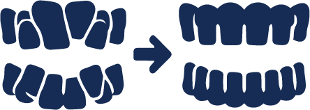 Invisalign for Crowding and Spacing​