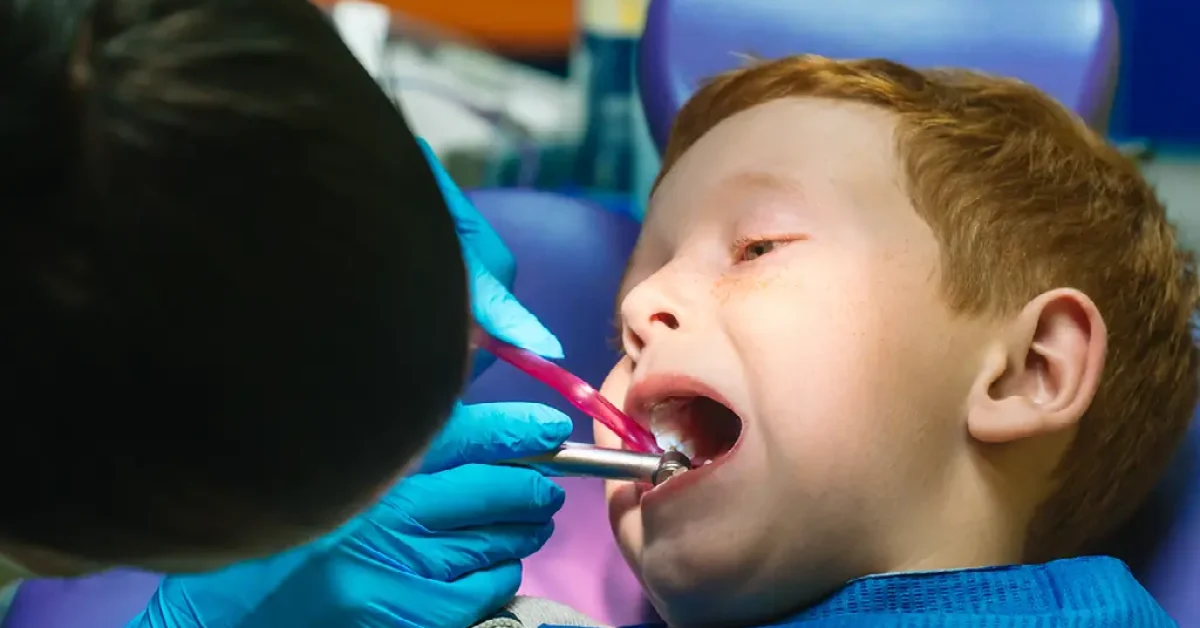 Importance of Silver Diamine Fluoride